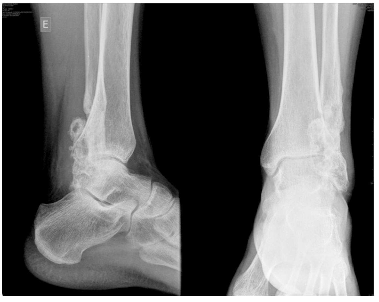 fibroma condromixoide