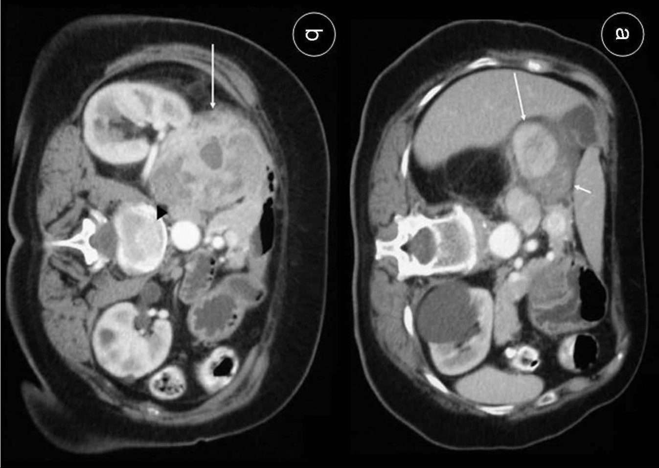 tumor fibroso